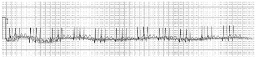 Electrocardiogram waveform display method and related device