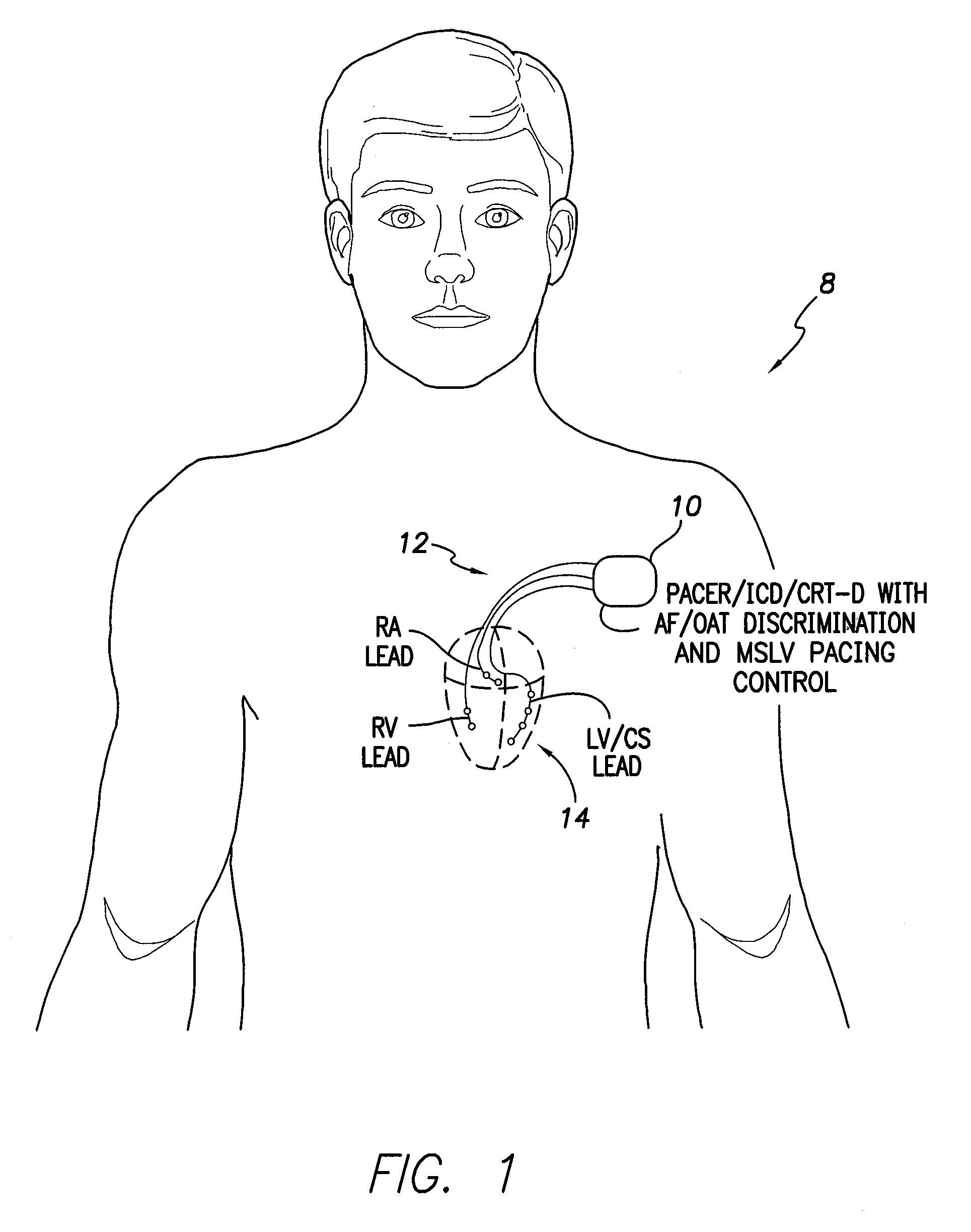 Systems and methods for use by an implantable medical device for controlling multi-site CRT pacing in the presence of atrial tachycardia