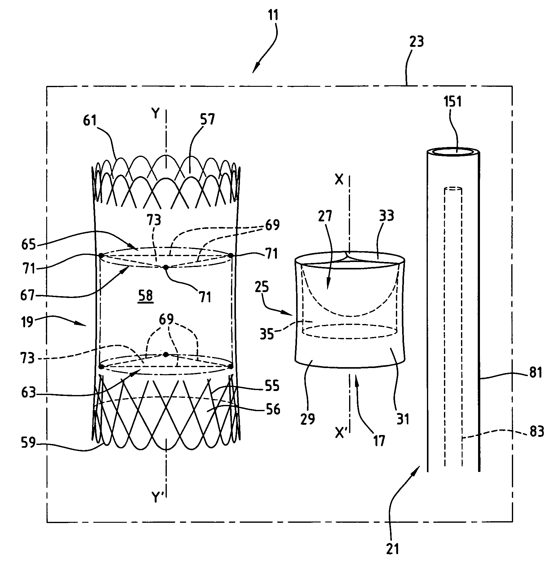 Kit to be implanted in a blood circulation conduit