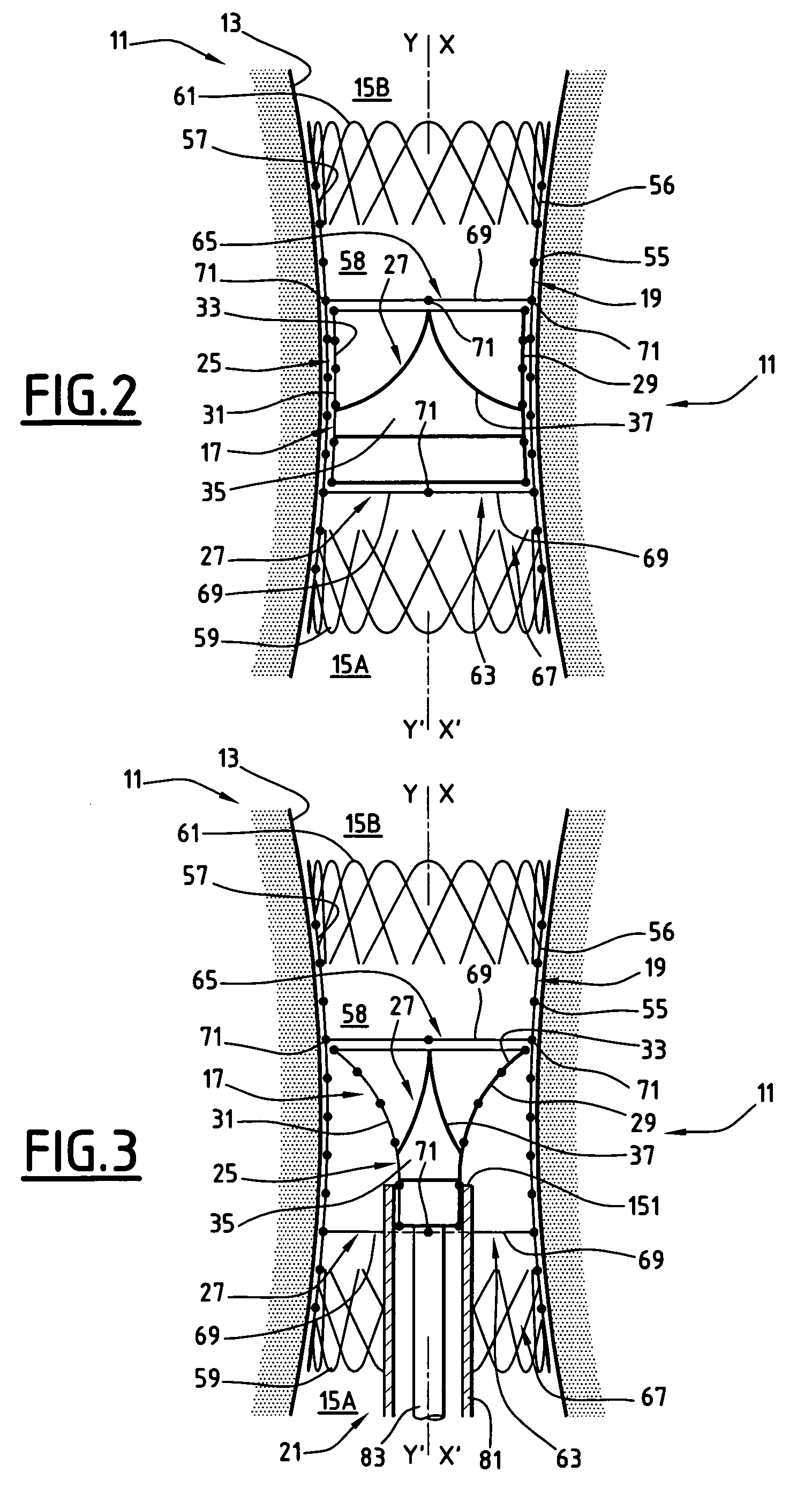 Kit to be implanted in a blood circulation conduit