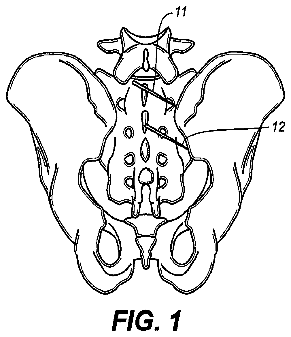 Minimally invasive surgical systems for fusion of the sacroiliac joint