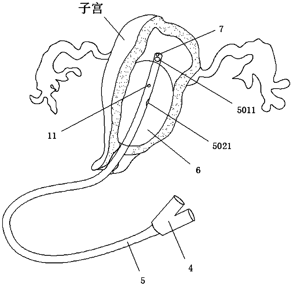 Hemostasis balloon for obstetrics and gynecology