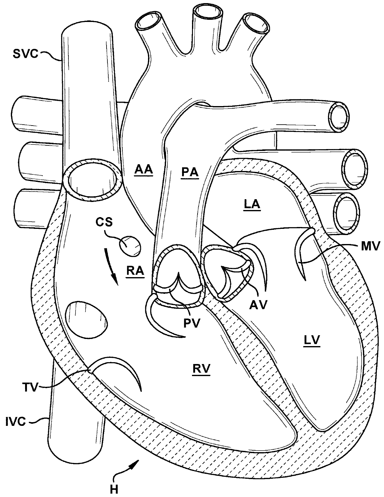 Native valve repair devices and procedures