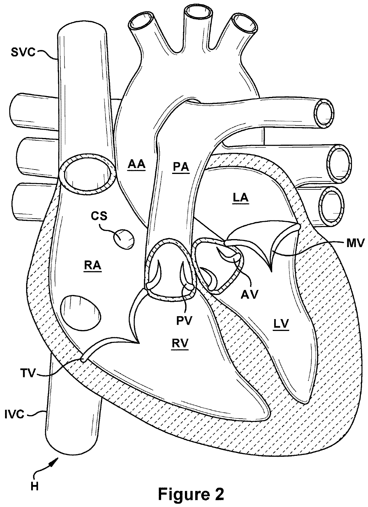 Native valve repair devices and procedures