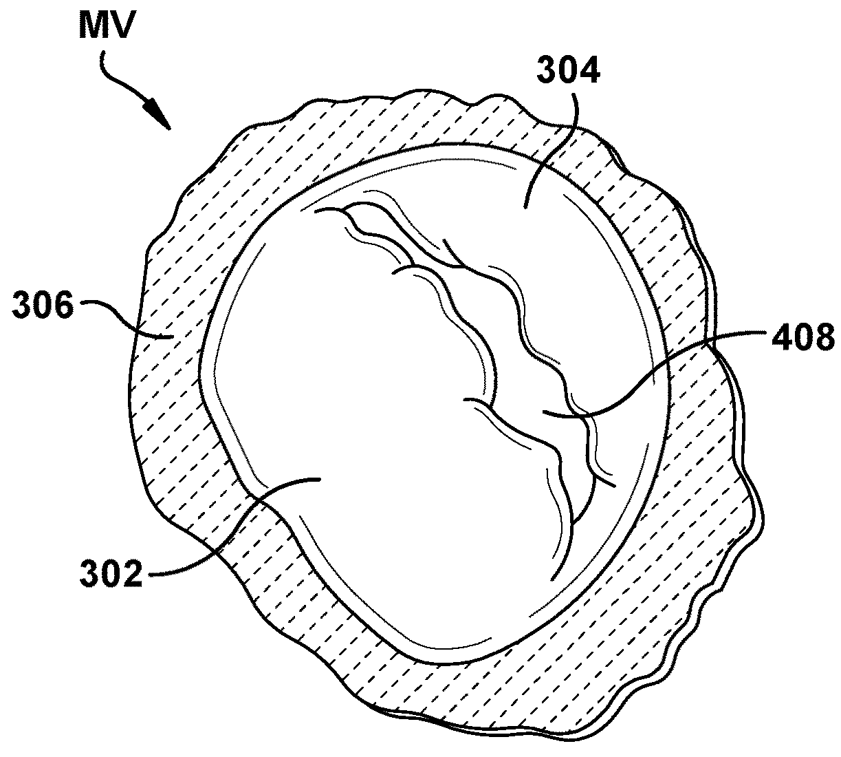 Native valve repair devices and procedures