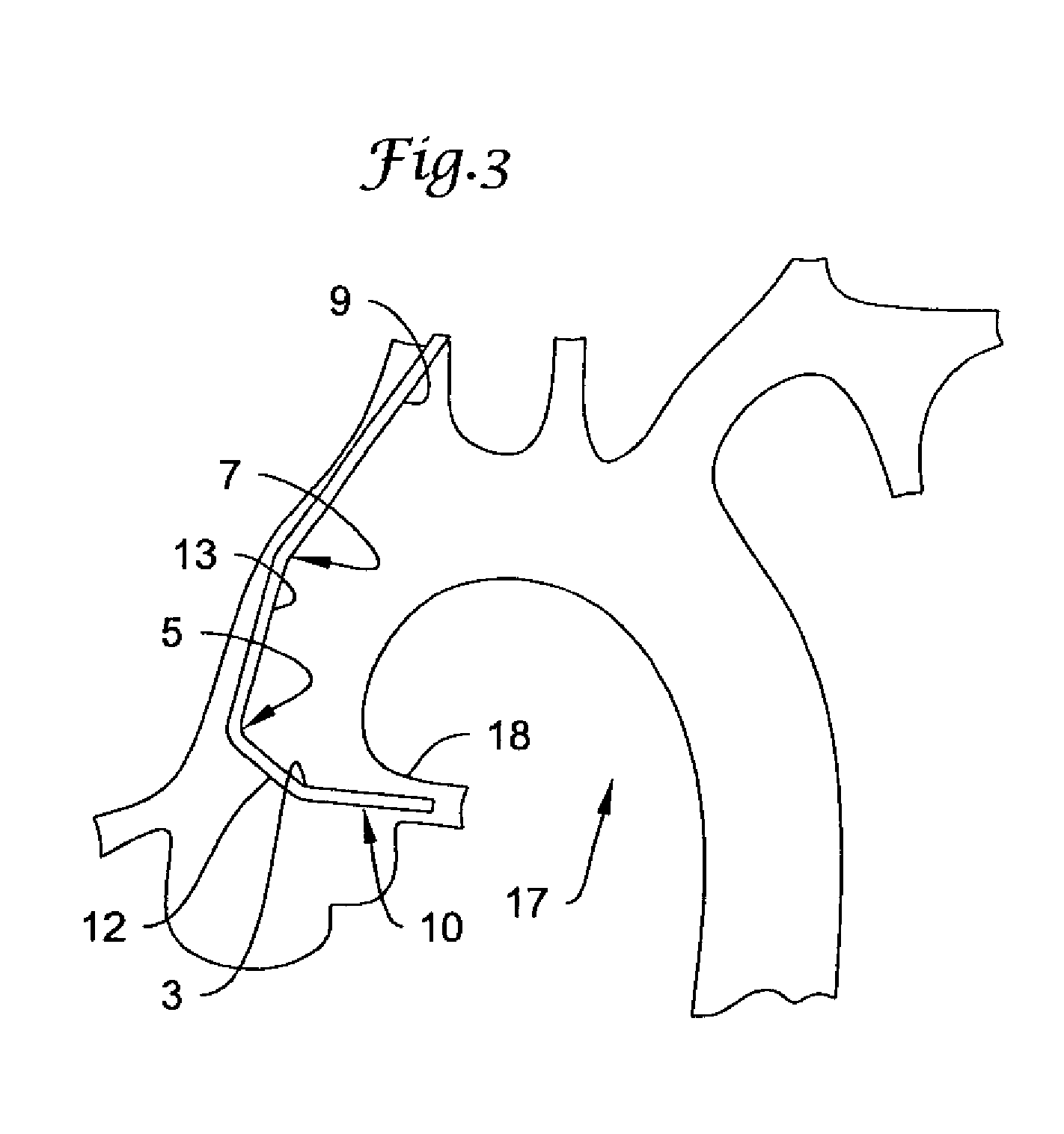 Catheter for percutaneous transradial approach