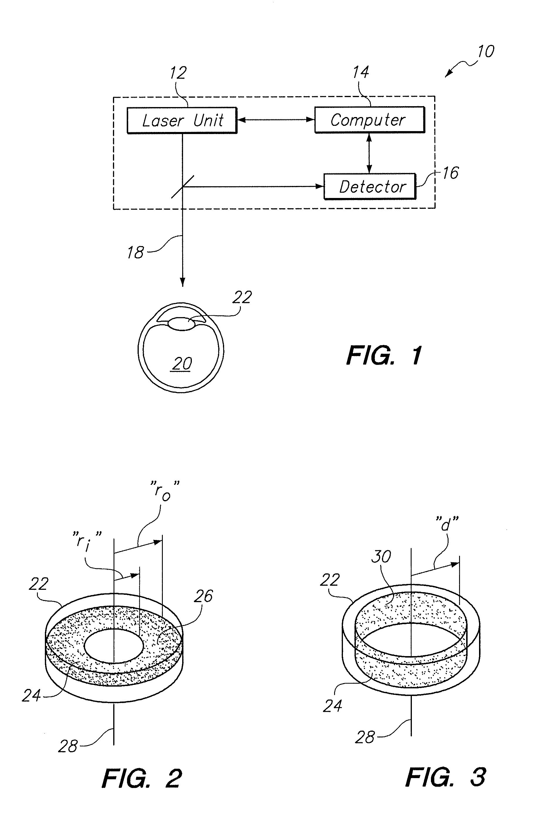 System and method for in situ creation of a small aperture intraocular lens