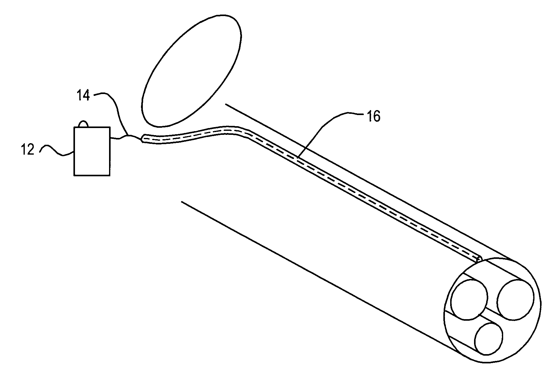 Implantable device and method for managing erectile dysfunction