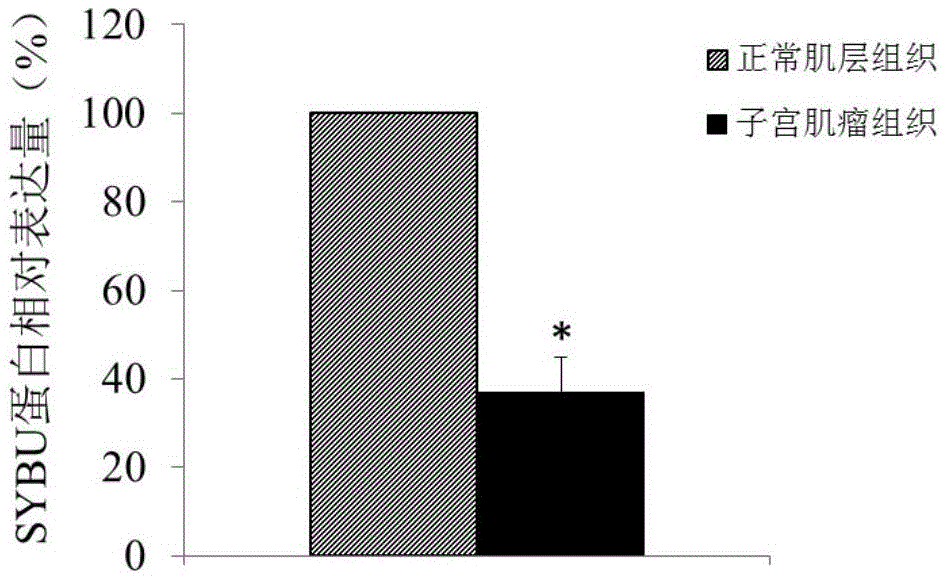 Molecular marker for diagnosing and treating hysteromyoma