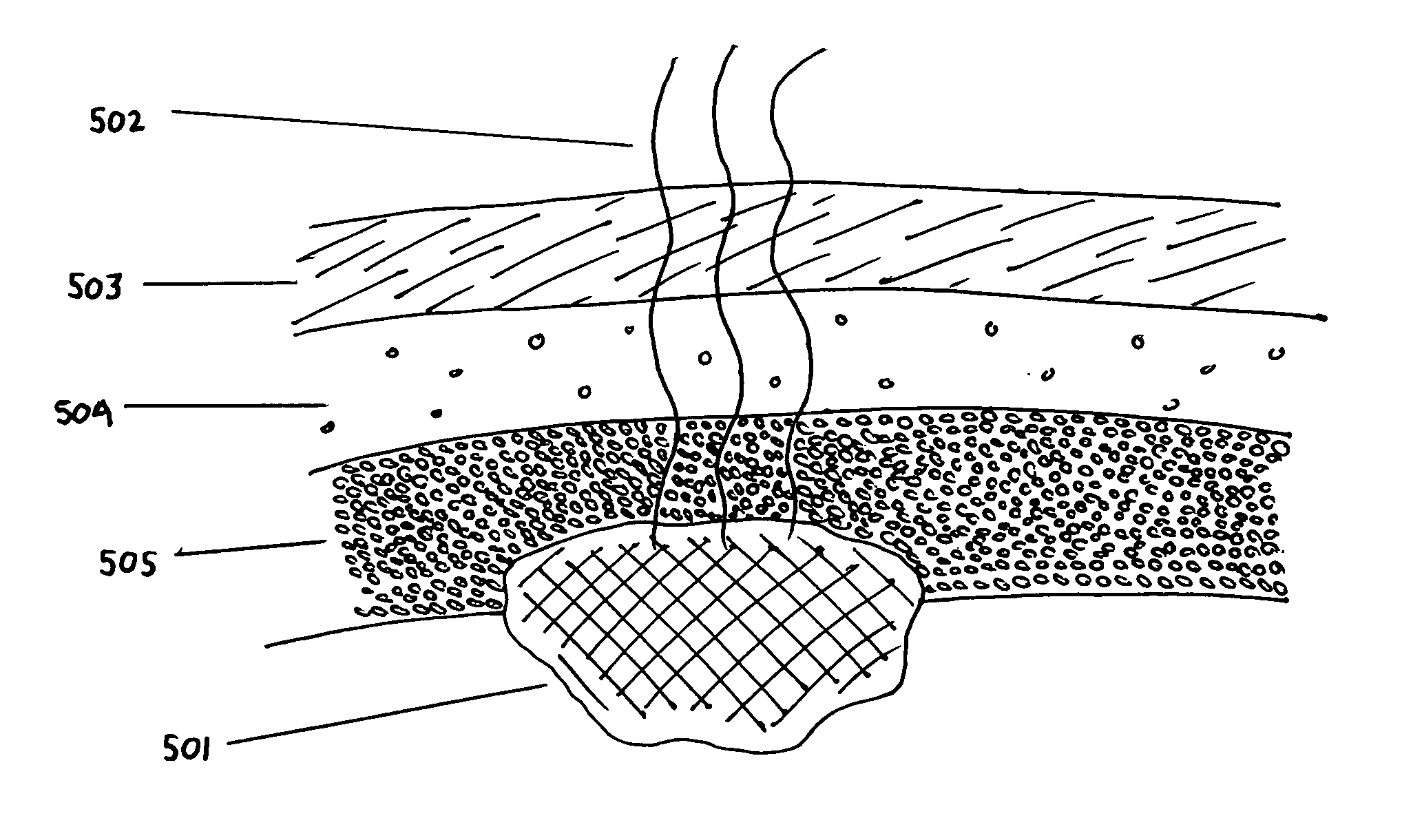 Method of Marking Biological Tissues for Enhanced Destruction by Applied Radiant Energy