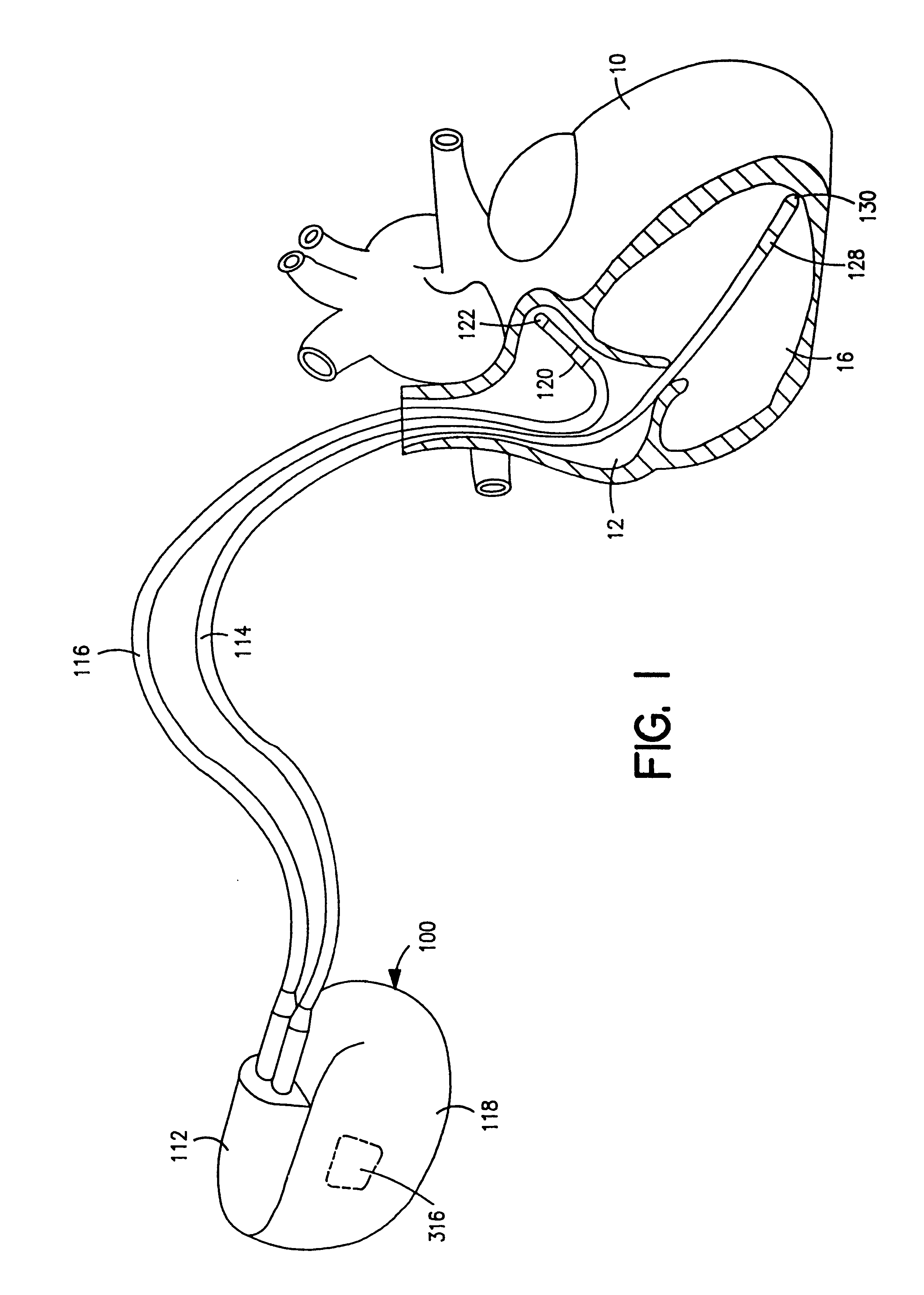 Dual-chamber pacemaker with optimized PVARP following event that may disrupt AV synchrony