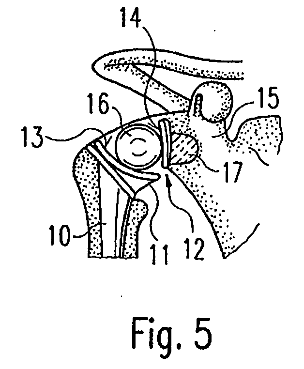 Glenoid prosthesis and method of implanting same