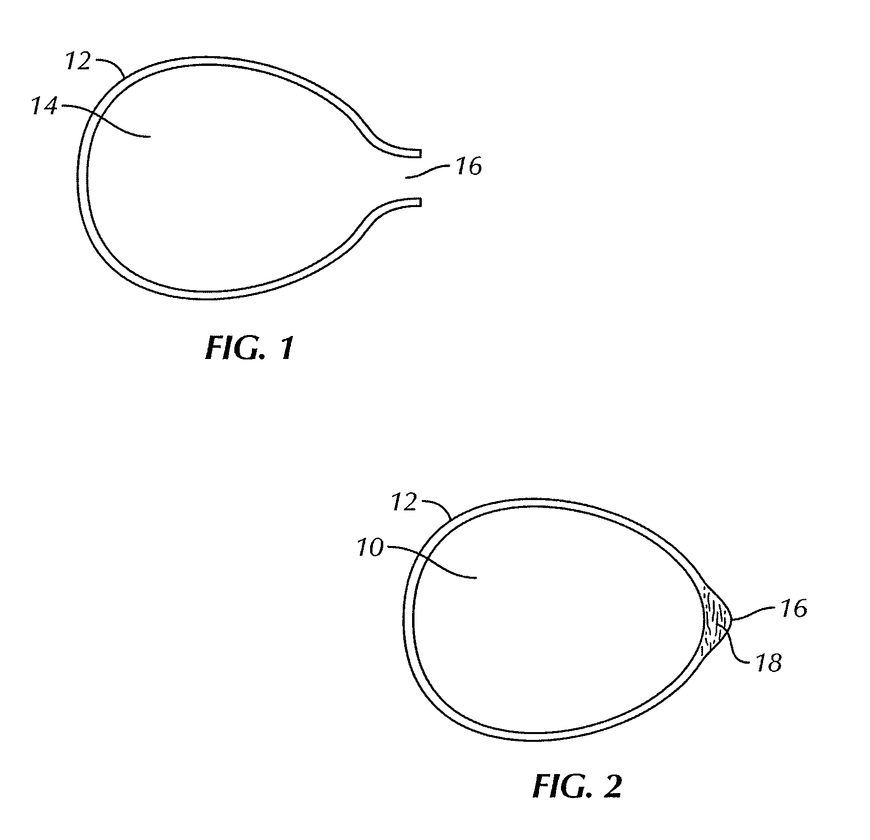 Breast implant implantation method and apparatus