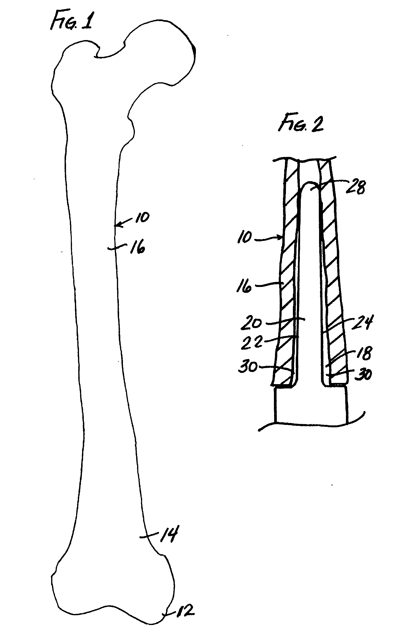 Modular implant system and method with diaphyseal implant