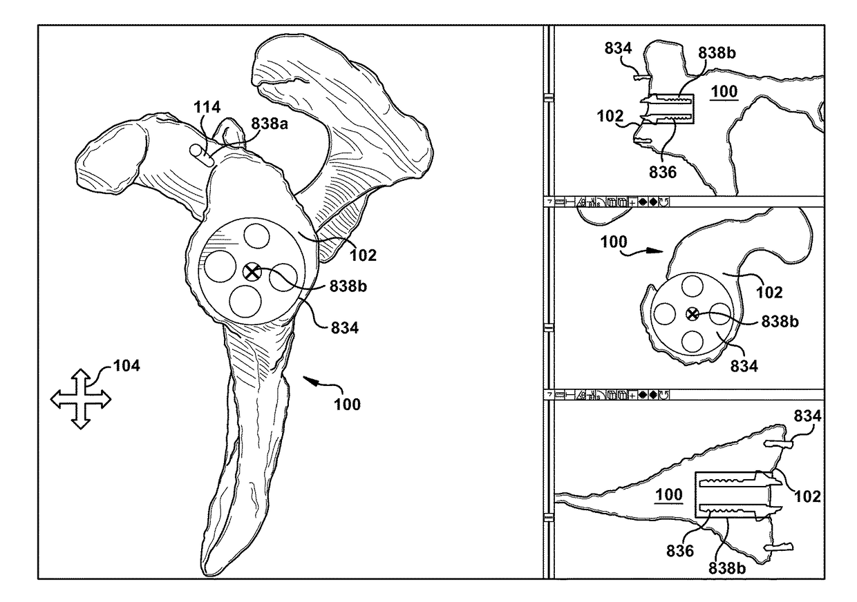 System and method for association of a guiding aid with a patient tissue