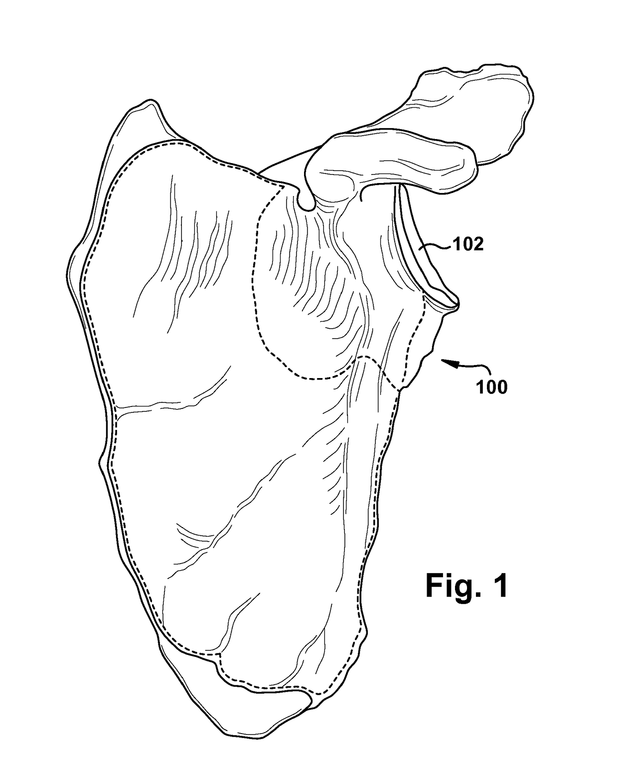 System and method for association of a guiding aid with a patient tissue