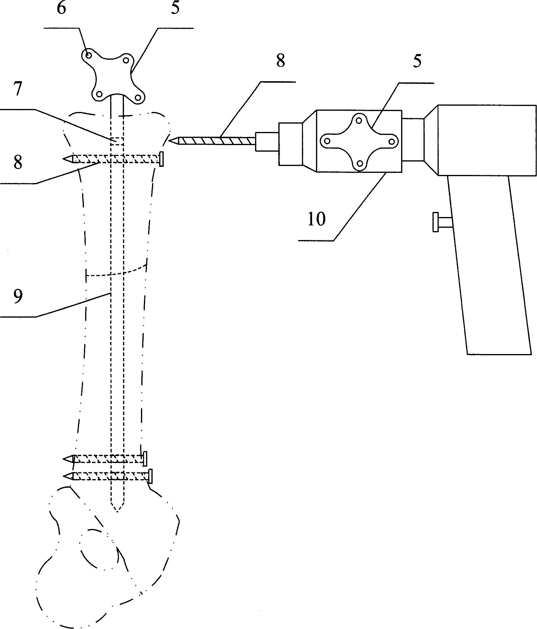 Orthopaedics operation navigation system