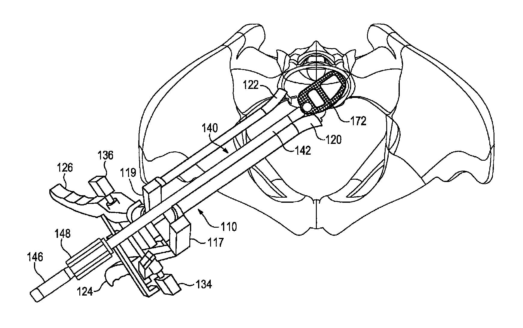 Method of retroperitoneal lateral insertion of spinal implants