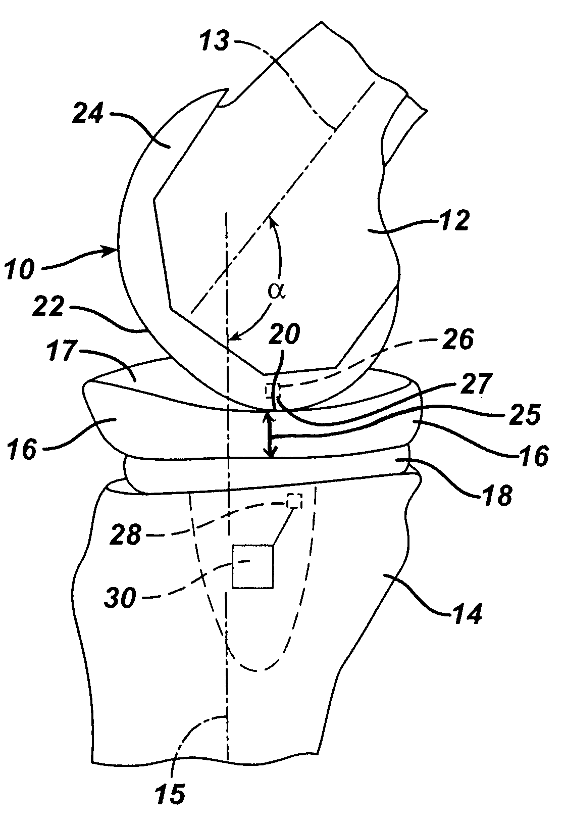 In vivo joint implant cycle counter