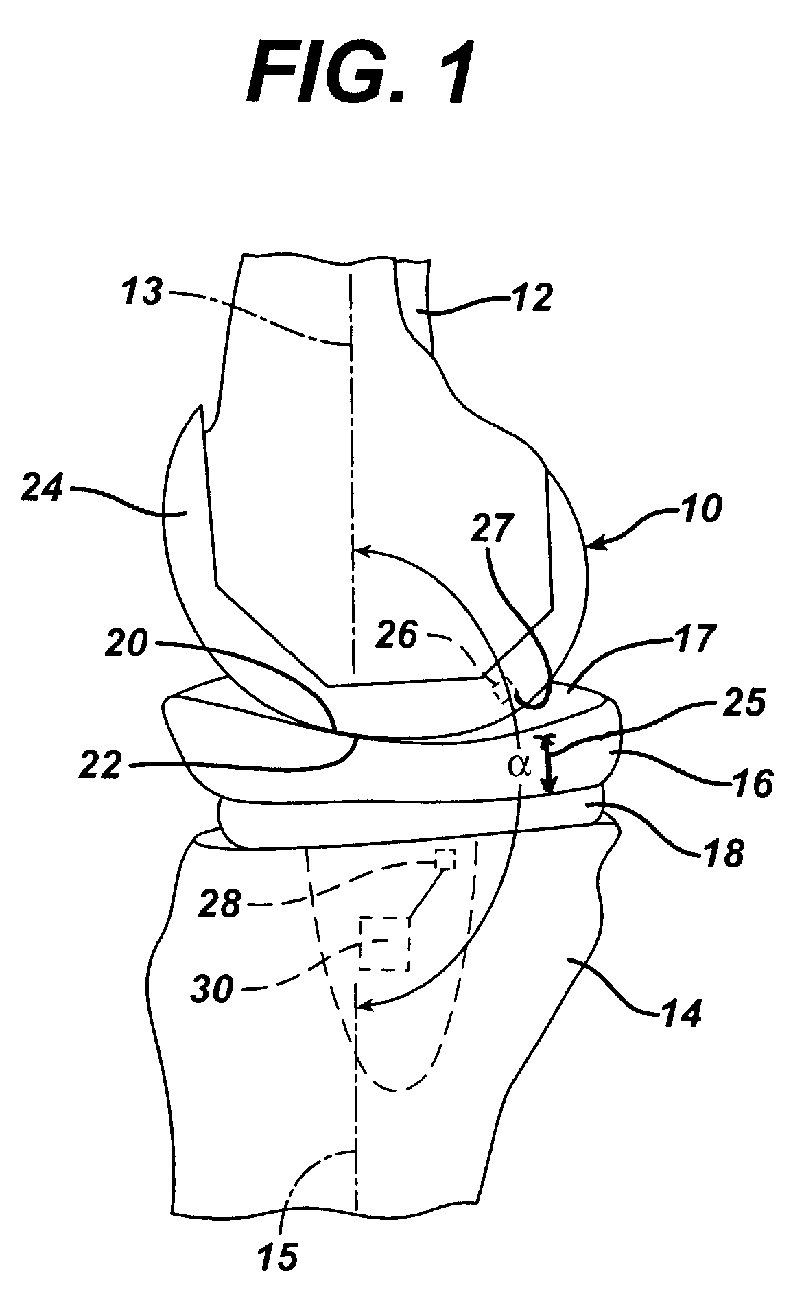 In vivo joint implant cycle counter