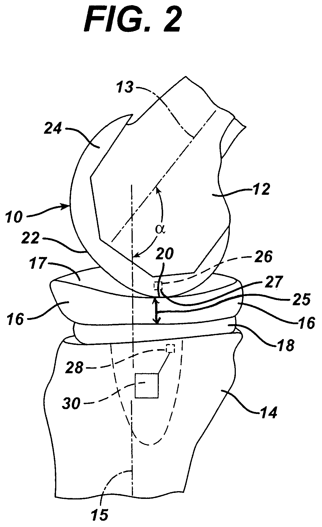 In vivo joint implant cycle counter