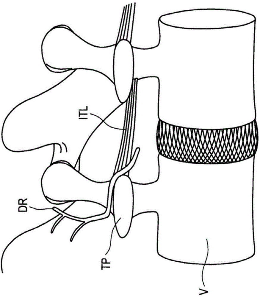 Apparatus and methods for anchoring electrode leads adjacent to nervous tissue