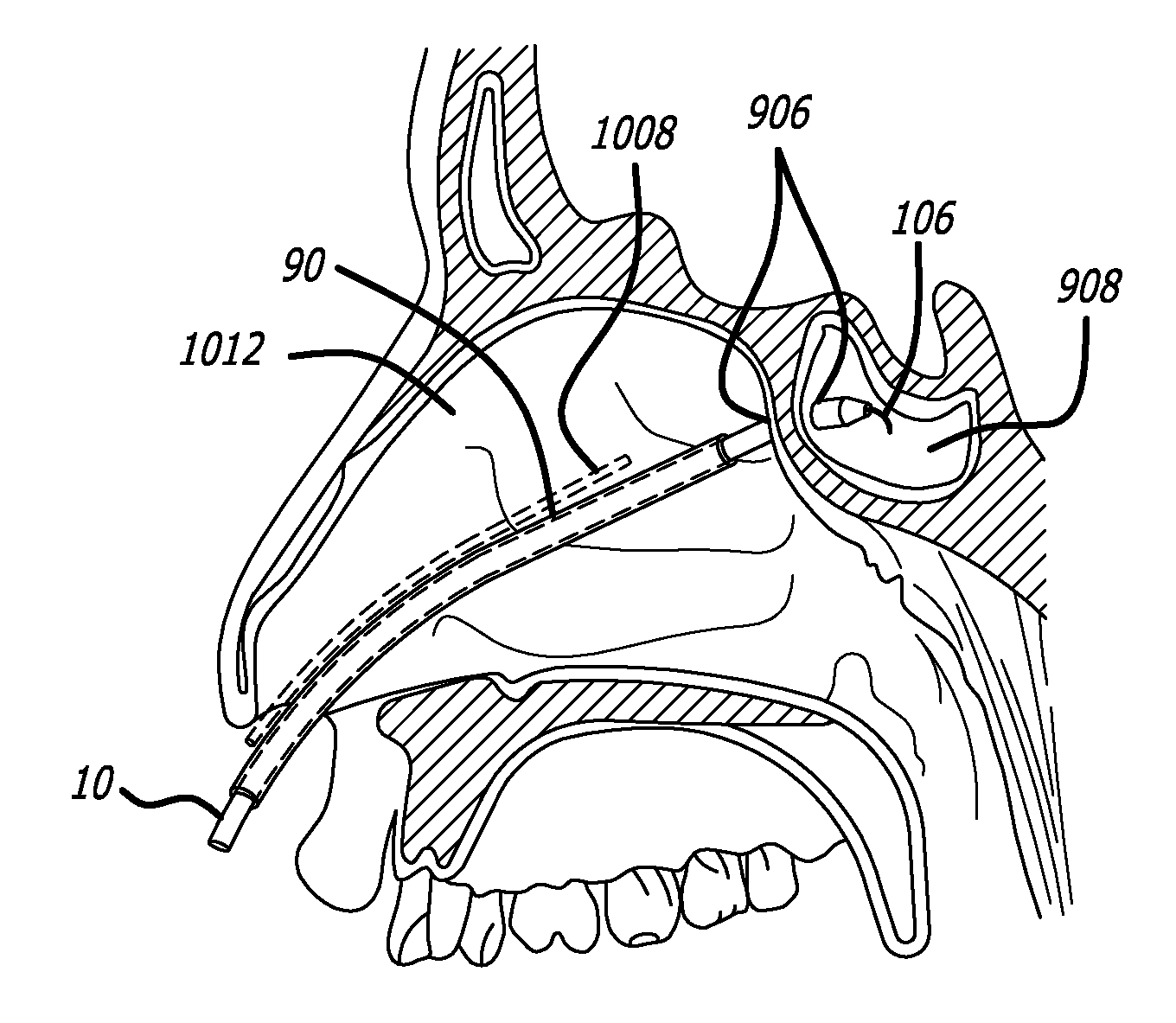 Methods, devices and systems for treating and/or diagnosis of disorders of the ear, nose and throat