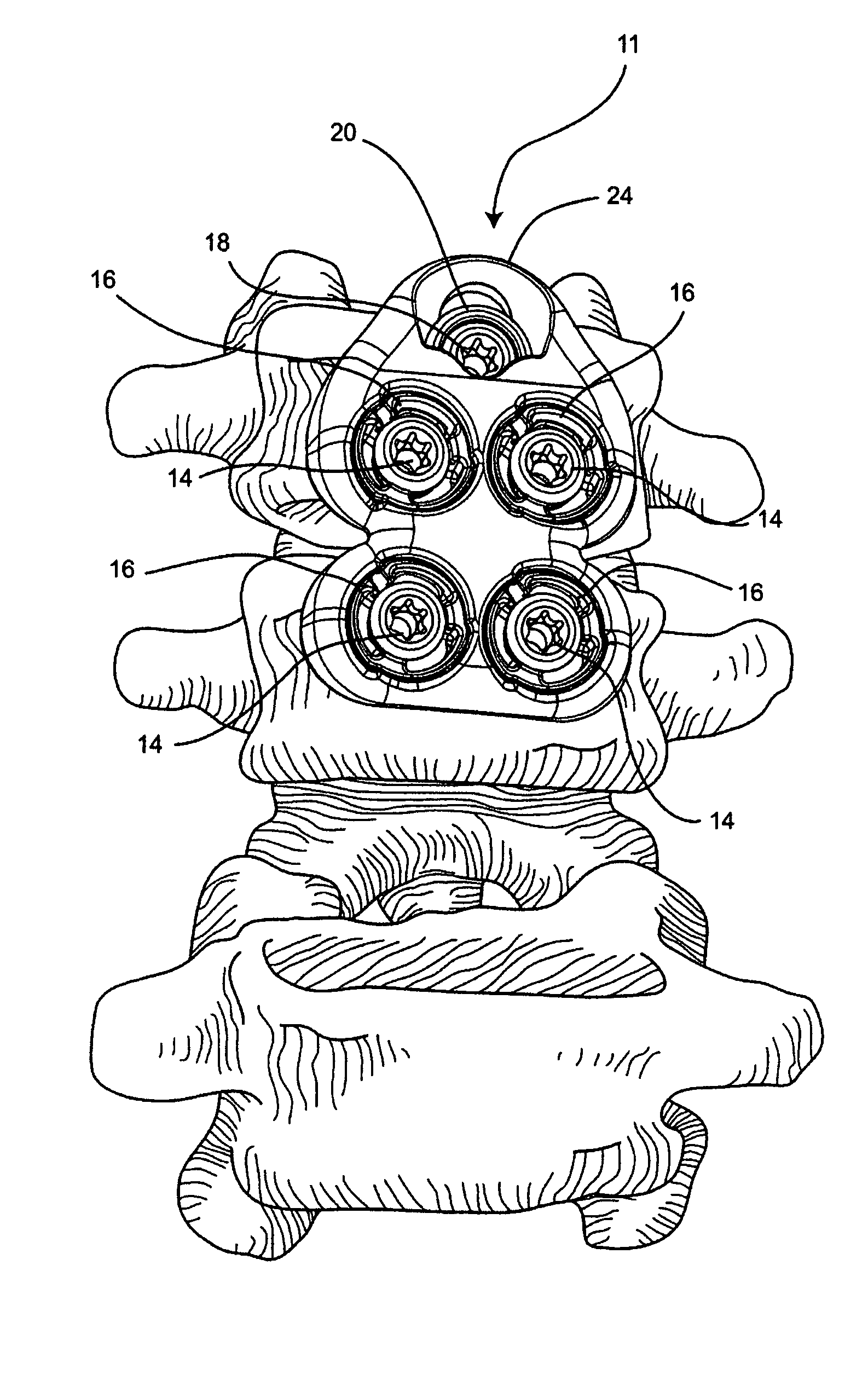 System and method for vertebral body plating