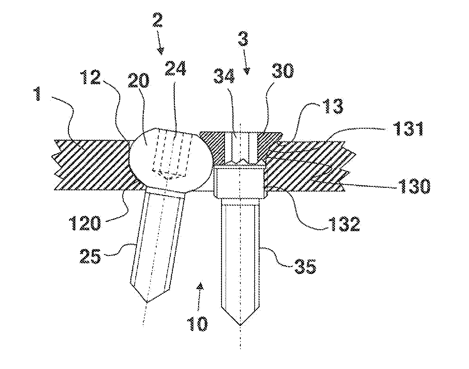 Bone Plate System for Osteosynthesis