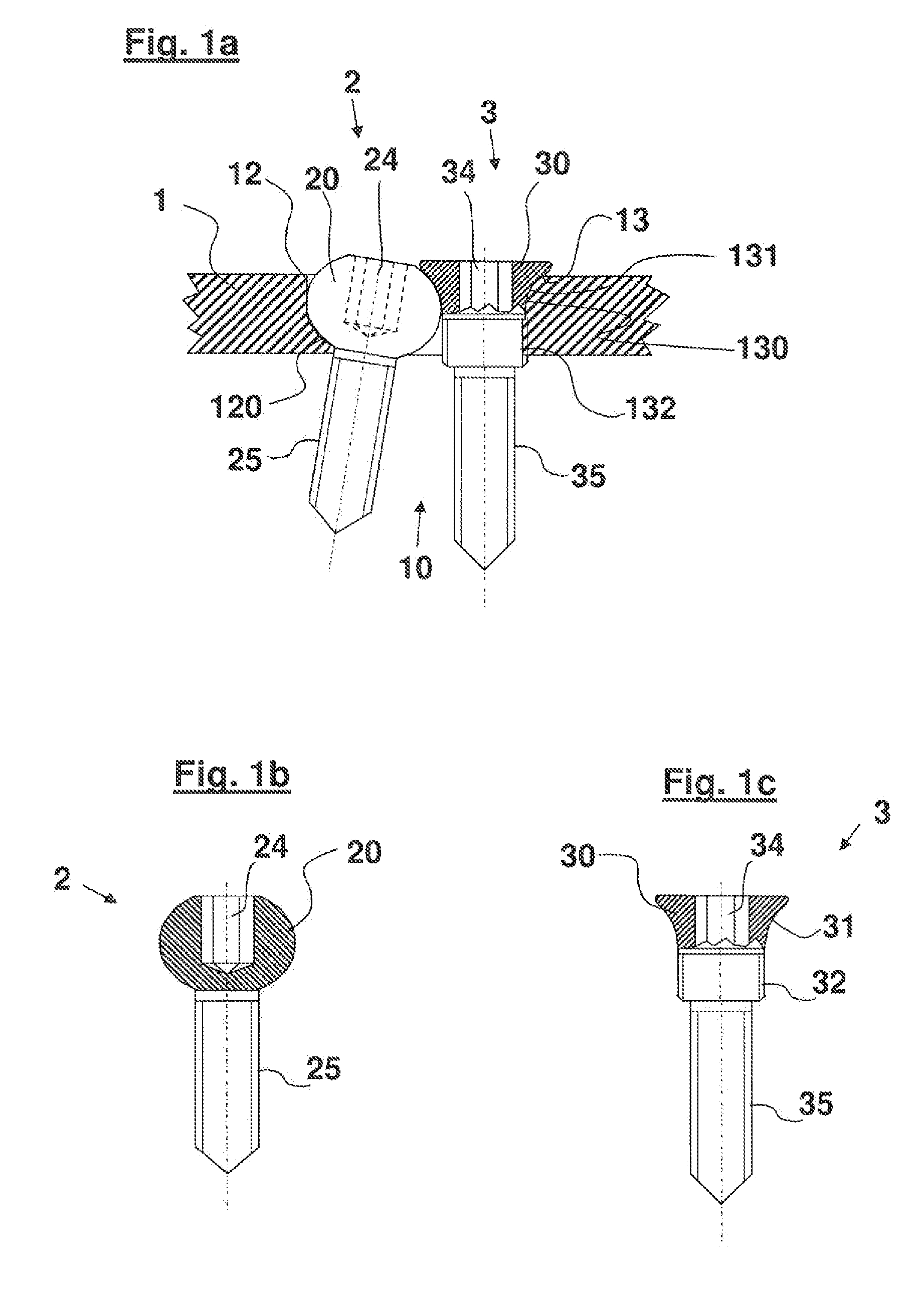 Bone Plate System for Osteosynthesis