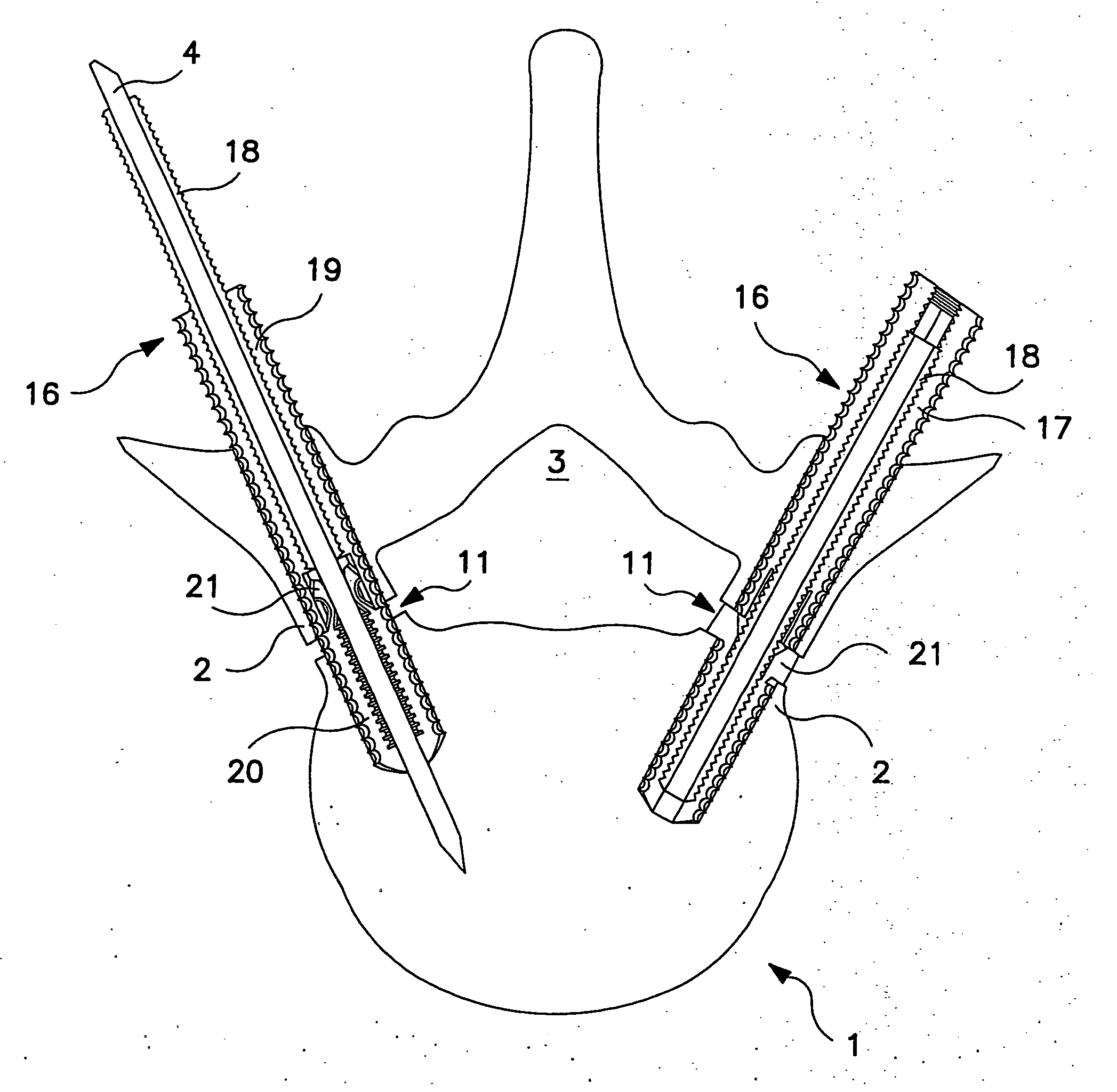 Percutaneous technique and implant for expanding the spinal canal