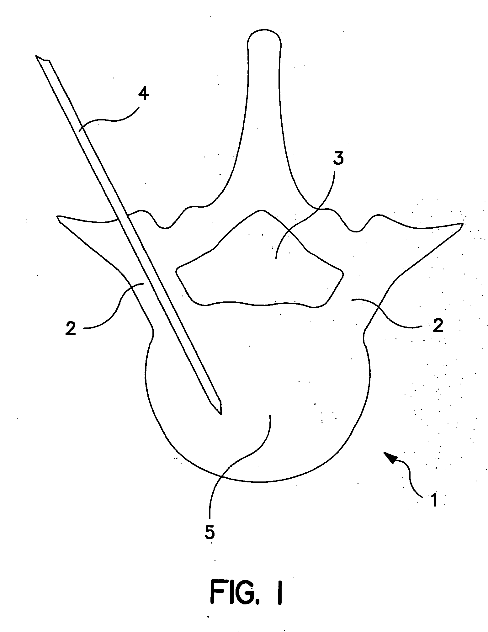 Percutaneous technique and implant for expanding the spinal canal