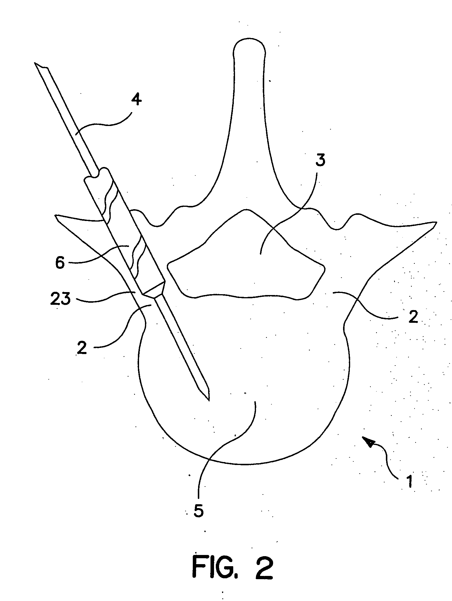 Percutaneous technique and implant for expanding the spinal canal