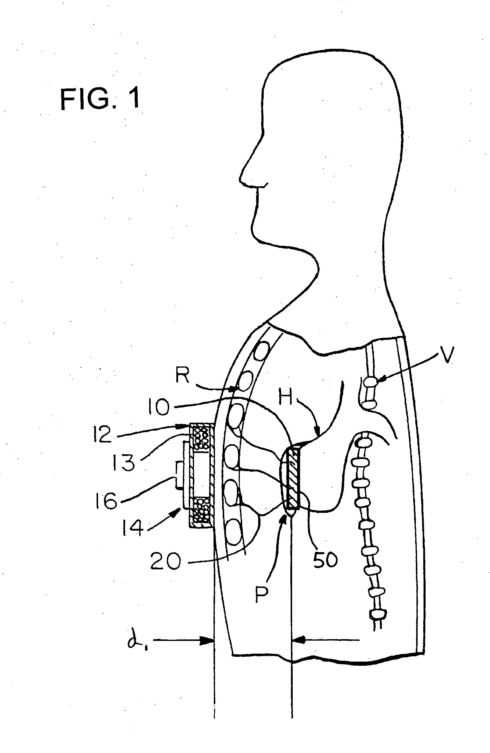 Cardiac tissue energy dispersion device