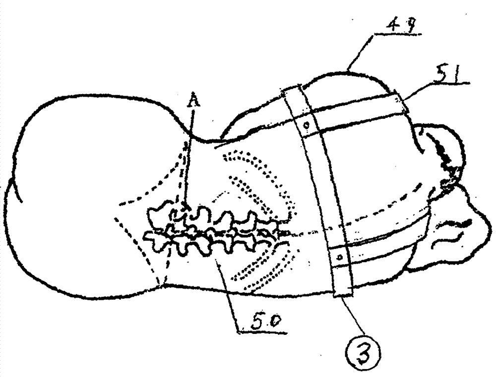 Medical neurology patient treatment and nursing bed