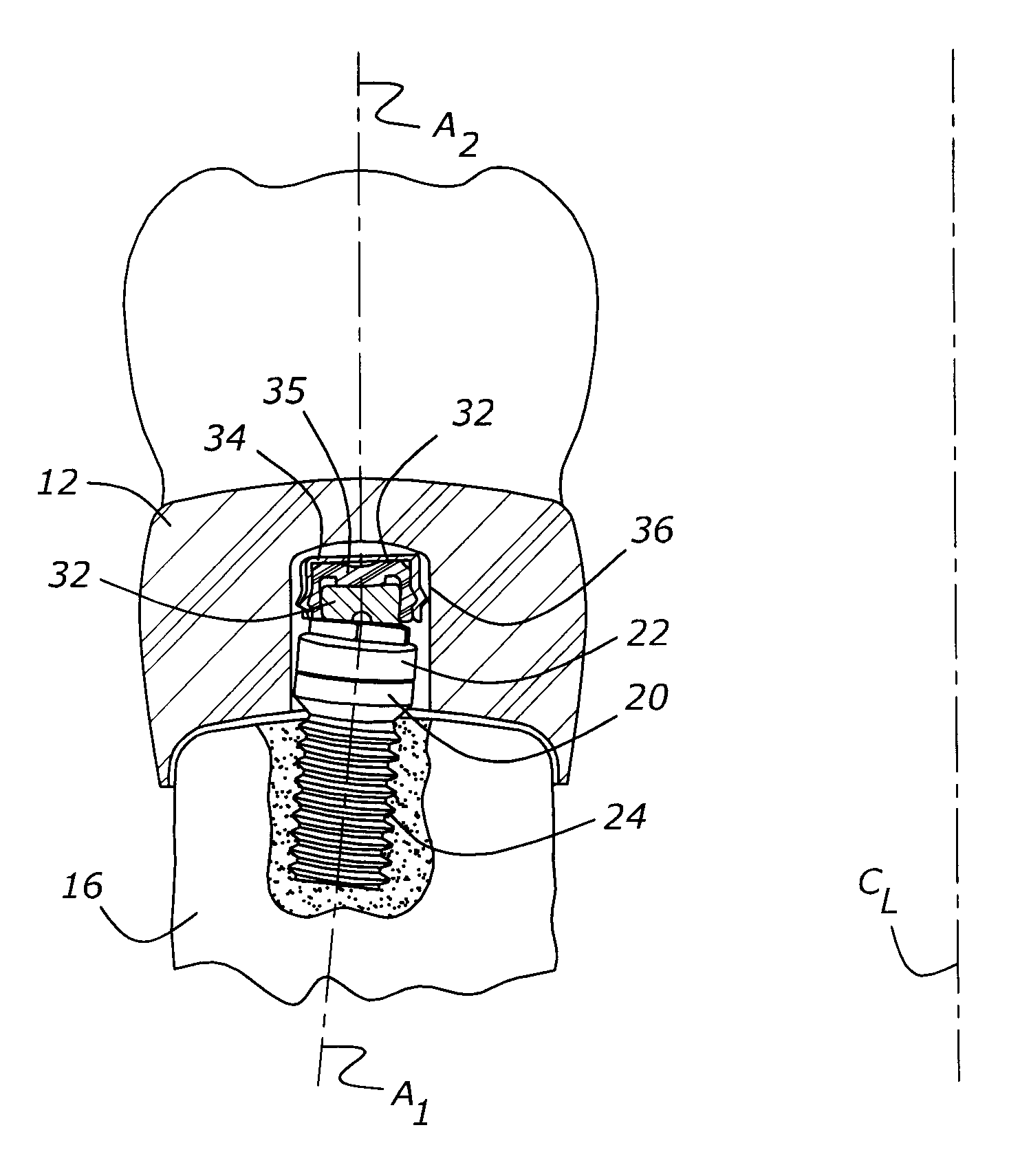 Dental abutment analog for implant-secured restoration