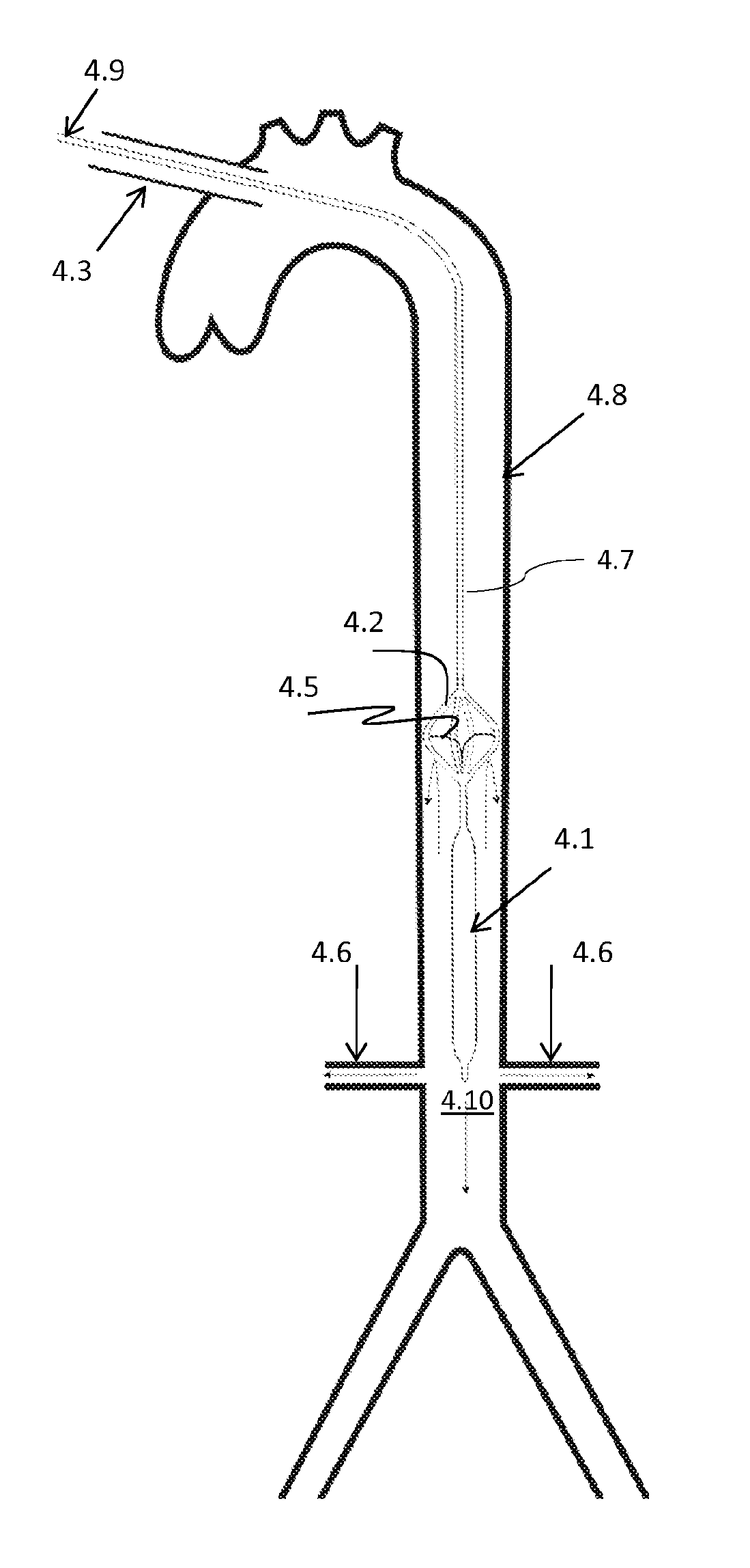 Intra-aortic balloon apparatus, assist devices and methods for improving flow, counterpulsation and haemodynamics