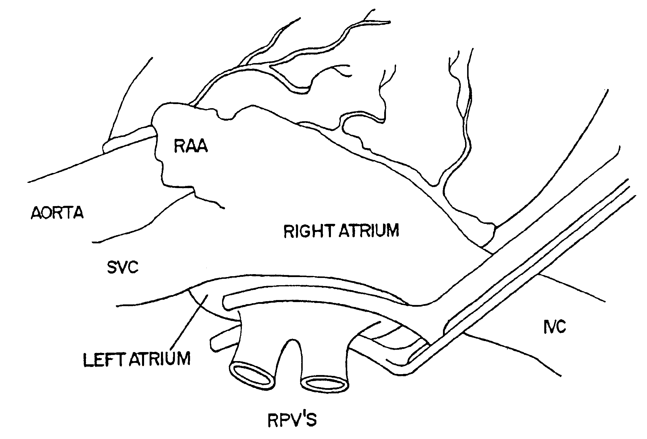 Transmural ablation device