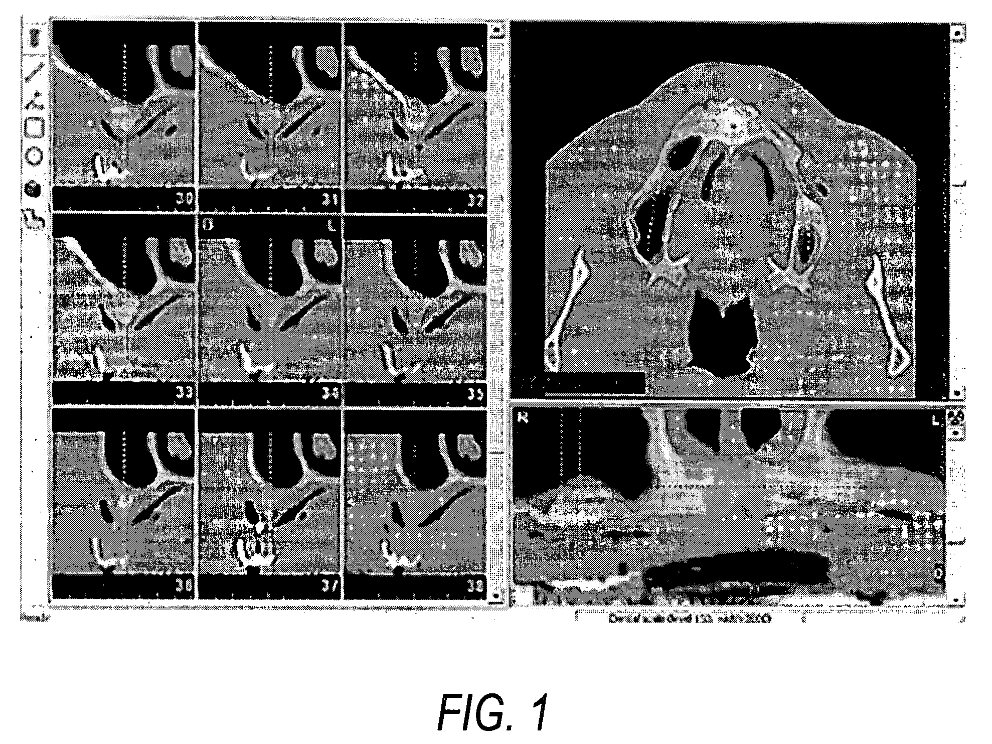 Surgical guide for use during sinus elevation surgery utilizing the Caldwell-Luc osteotomy