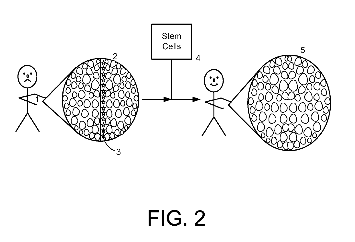 Collection of amniotic fluid for wound healing