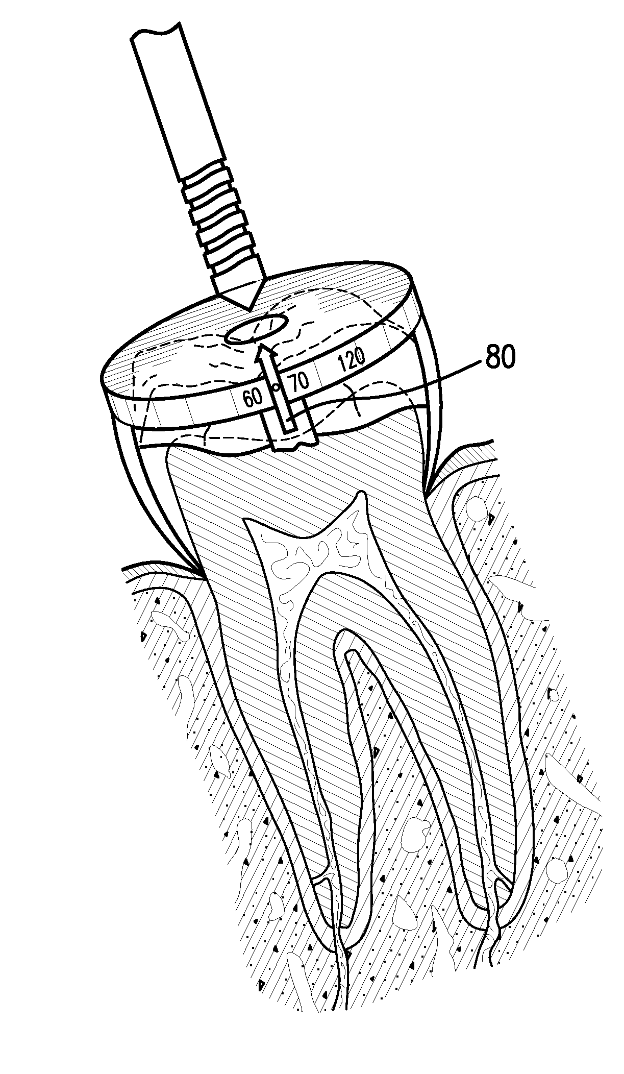 Device and method for locating a pulp chamber in a tooth