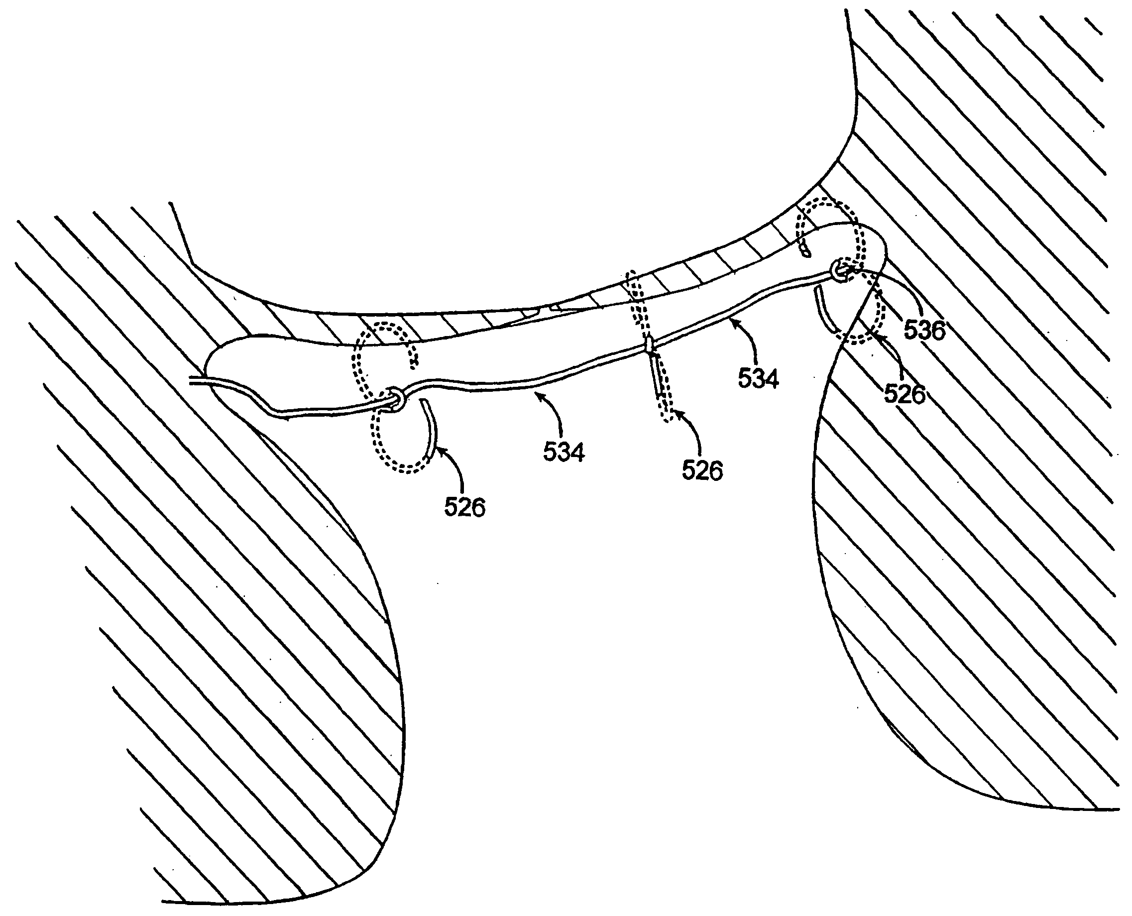 Methods and devices for termination