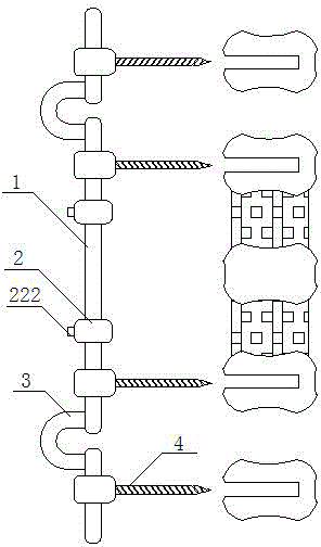 Extending tension type non-fusion fixation system