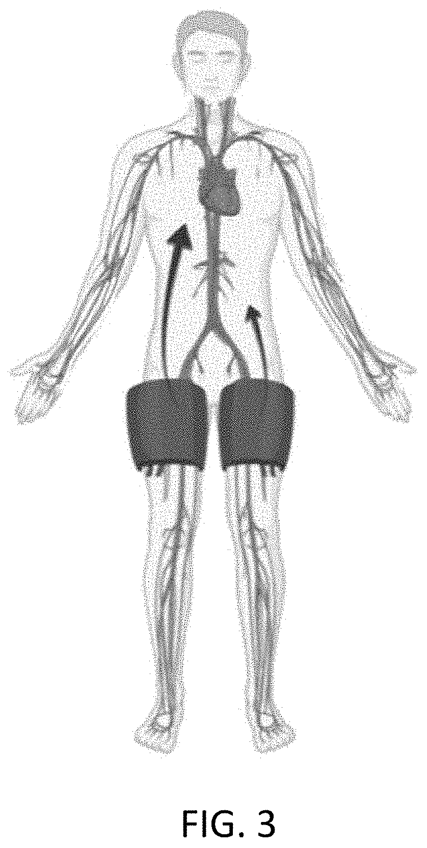 External vascular compression device for use during cardiac arrest