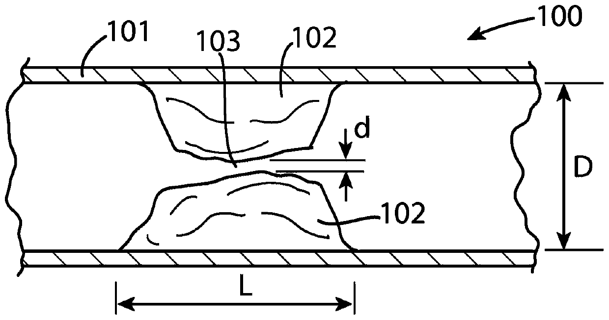 An expandable stent and a method for promoting a natural intracranial angiogenesis process, and use of the expandable stent in the method for promoting a natural intracranial angiogenesis process