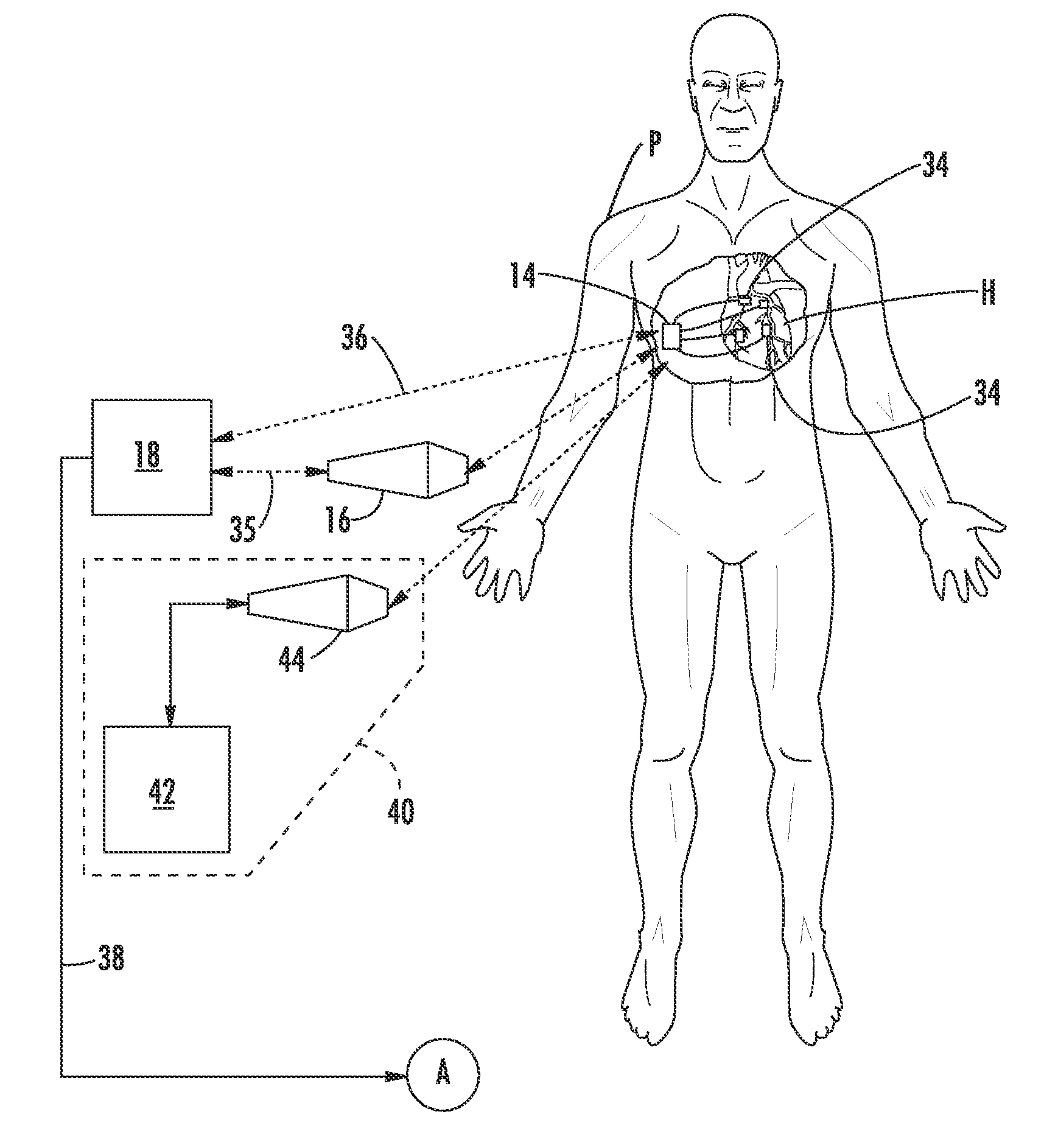 System and method for heart monitoring