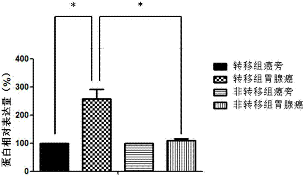 Biomarker for diagnosing and treating gastric adenocarcinoma metastasis