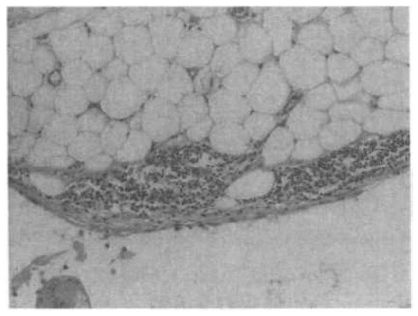 Anti-cancer medical adhesive as well as preparation method and application thereof