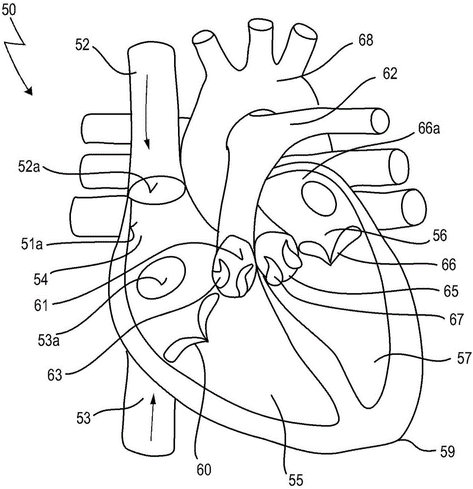 Implantable device for treating mitral valve regurgitation