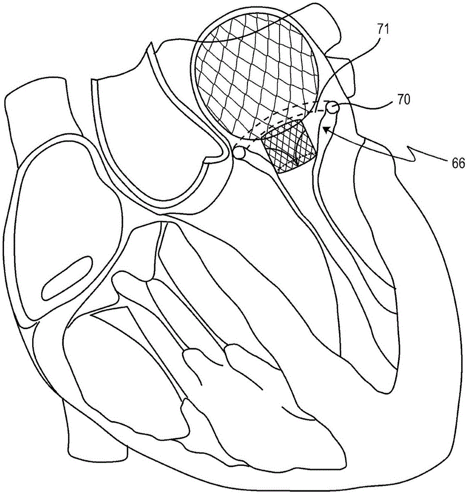 Implantable device for treating mitral valve regurgitation